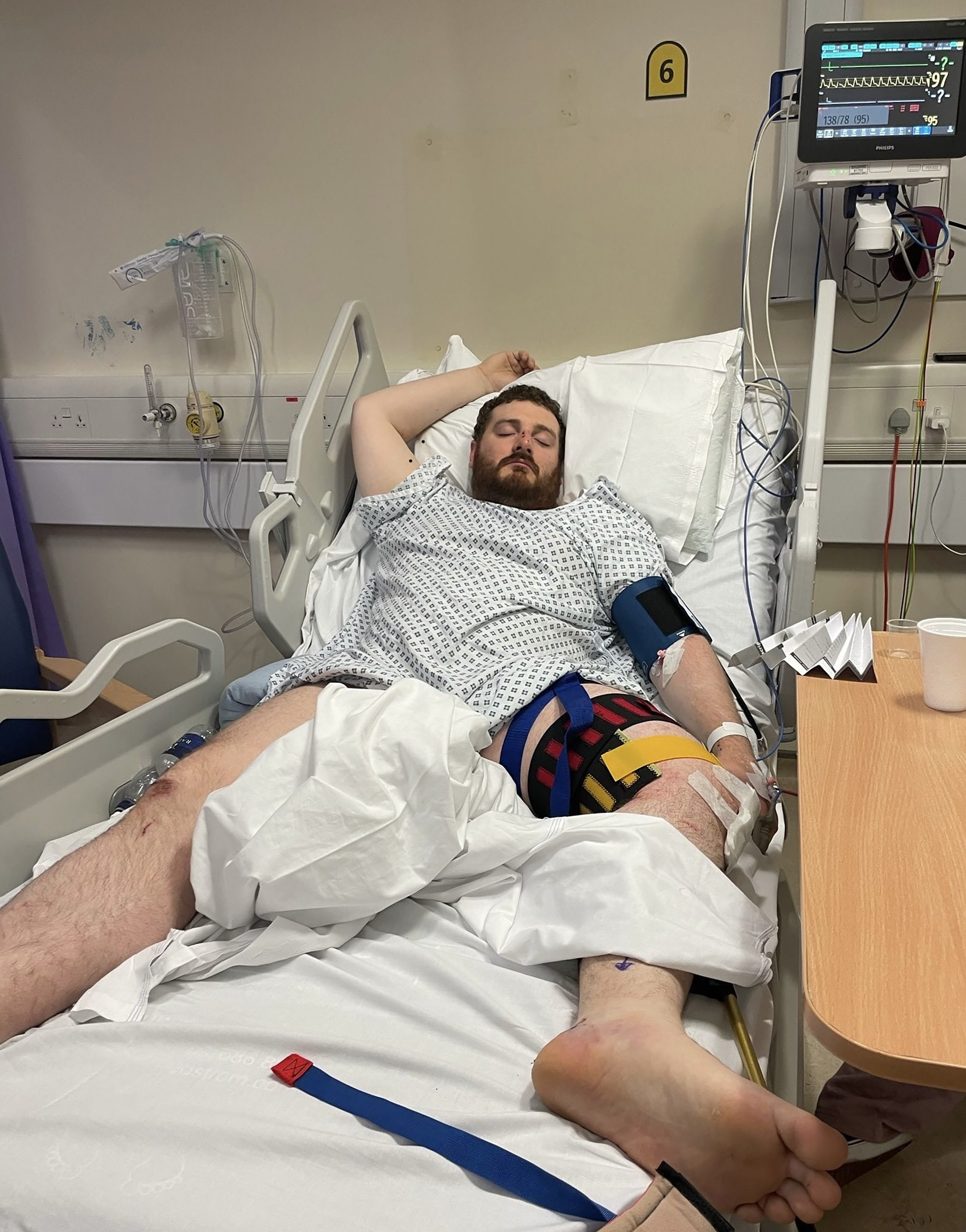 Adam verbrachte zwei Wochen im Krankenhaus und musste operiert werden, um einen Metallstab in sein verstümmeltes linkes Bein einzuführen