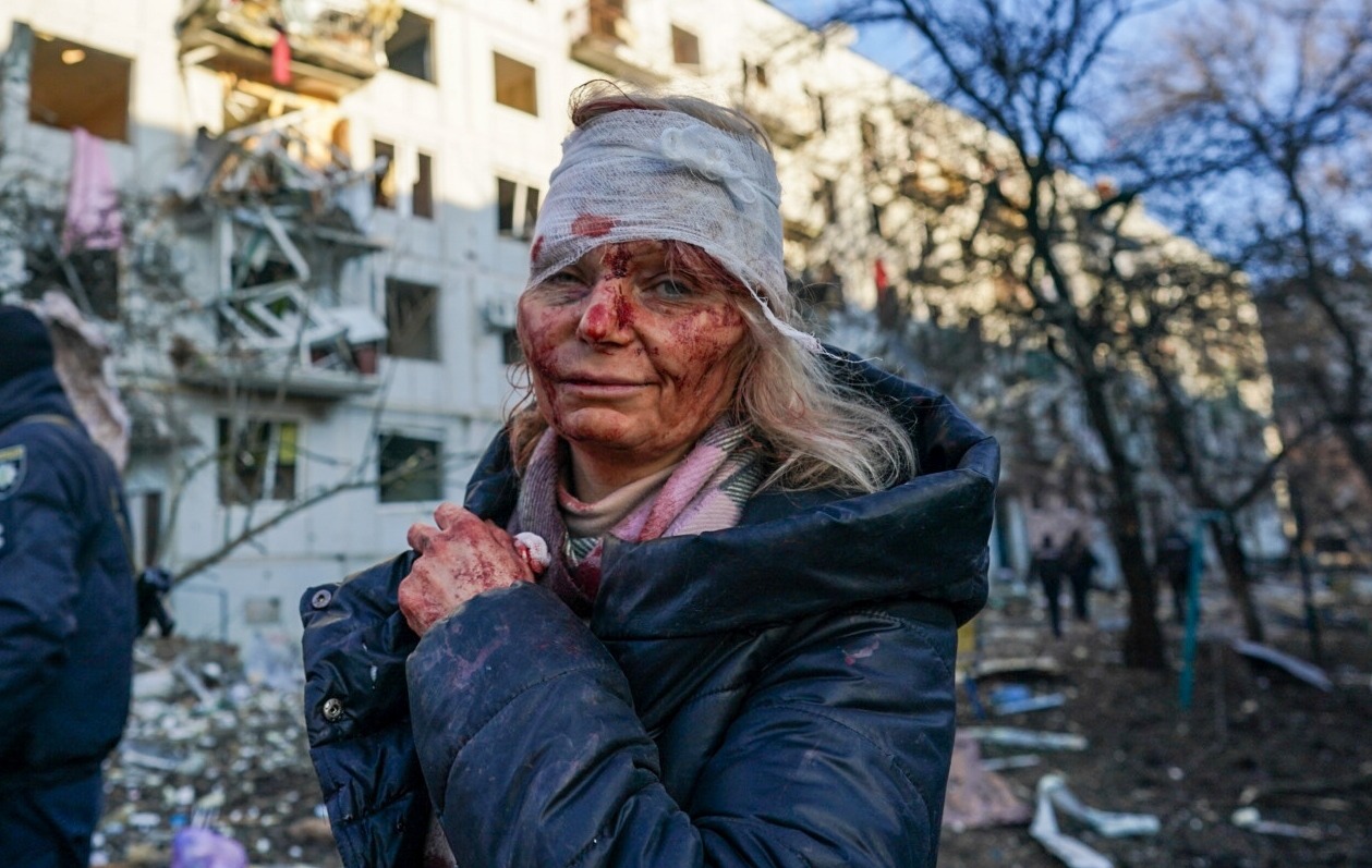 Olena wurde 2022 zum „Gesicht des Krieges“, nachdem sie bei einem Luftangriff eine Verletzung erlitten hatte